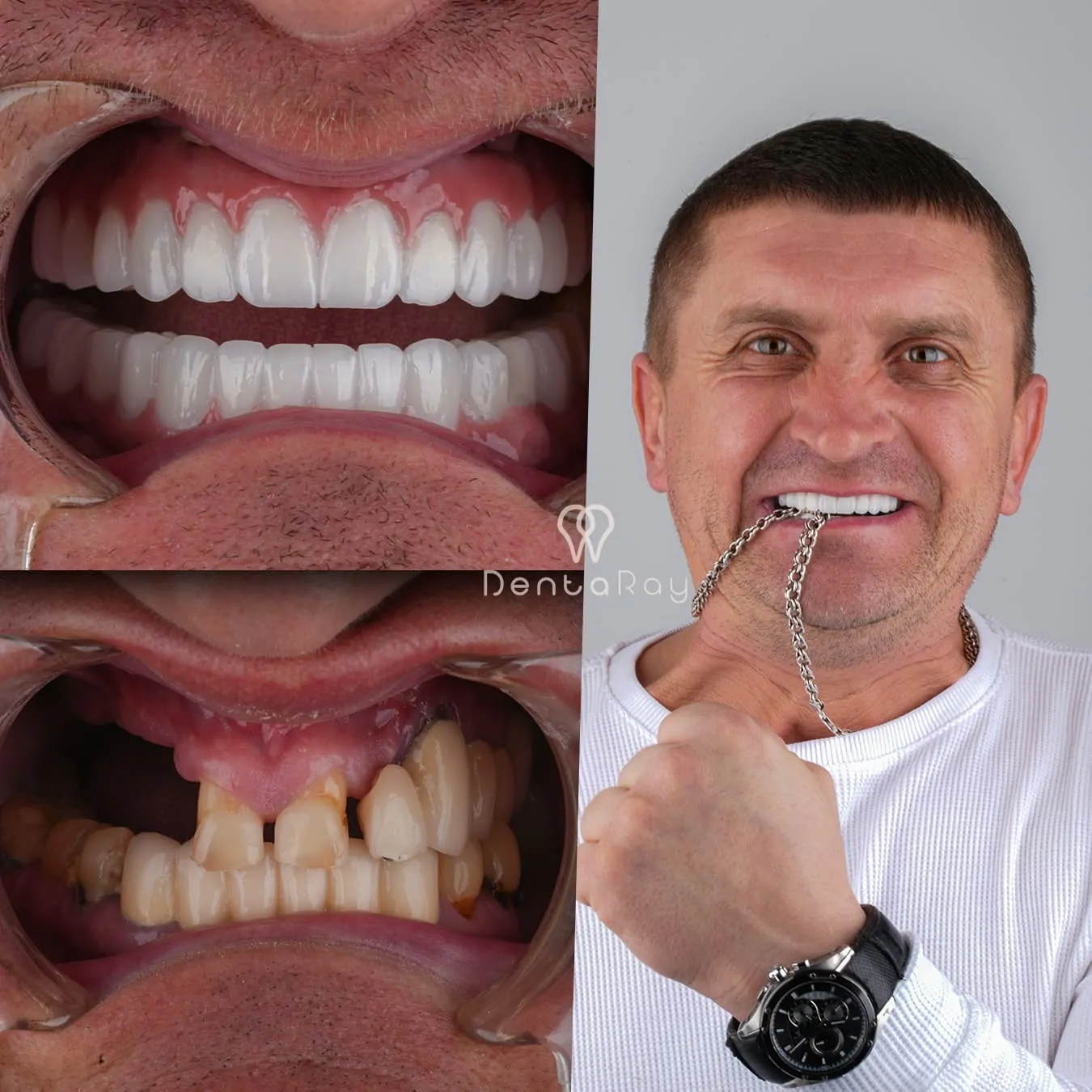 Ideal Candidate for Zygomatic Implants