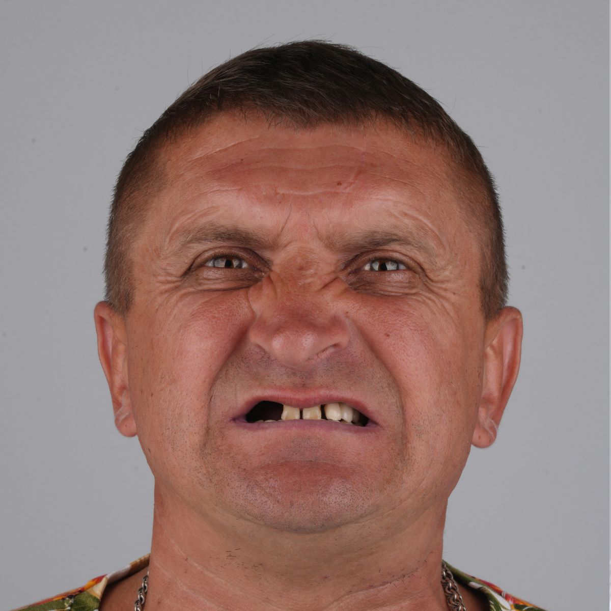 Anna After Treatment
