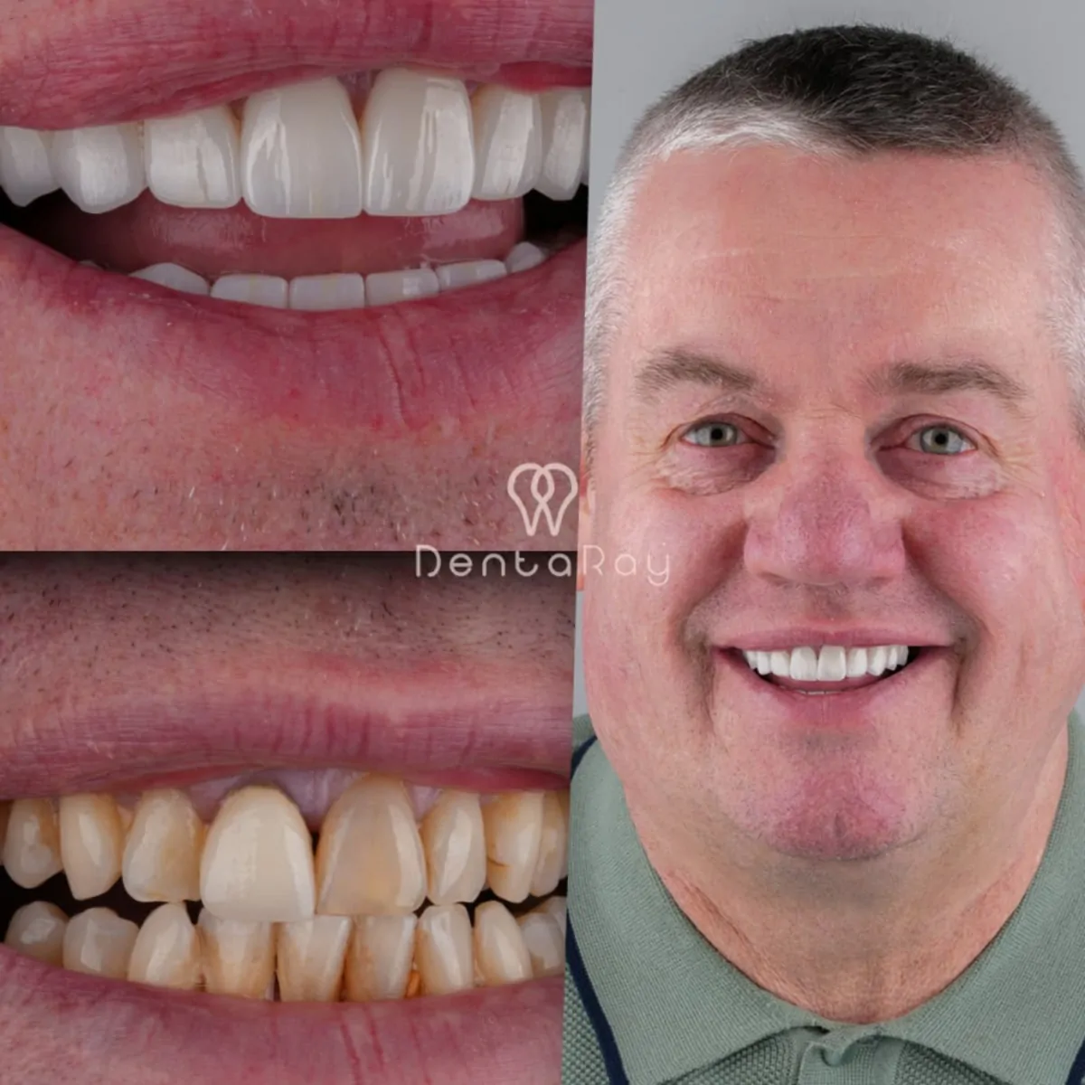 Zygomatic Dental Implants