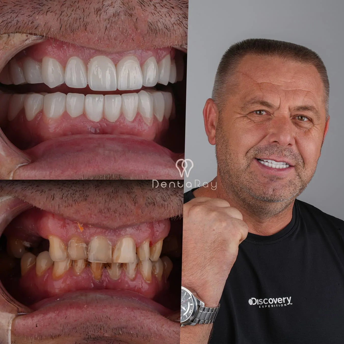 Dentaray Post-Operative Result