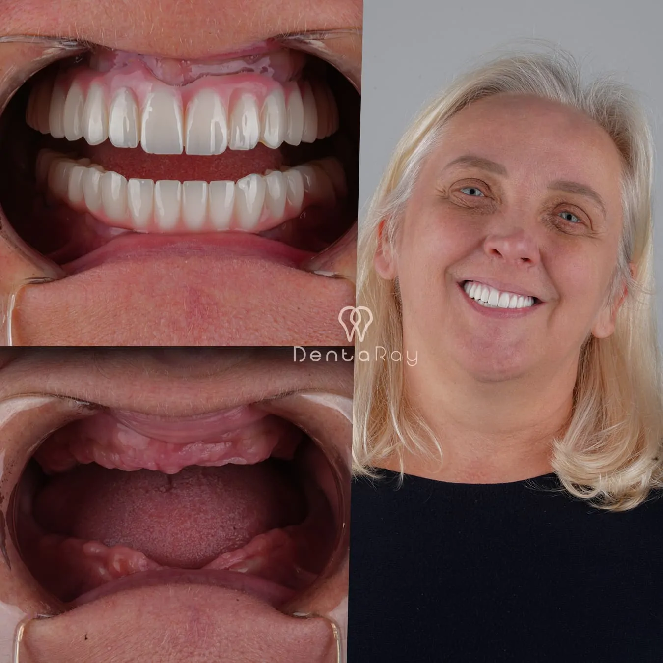 Dentaray Procedure Visualization