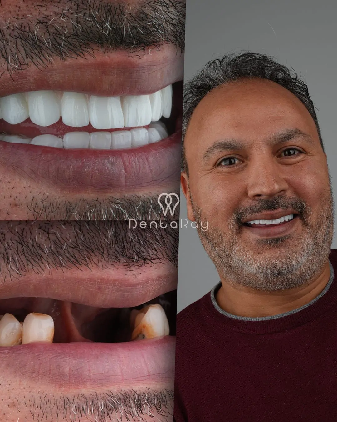 Detailed view of the All-on-6 Dental Implant Procedure structure
