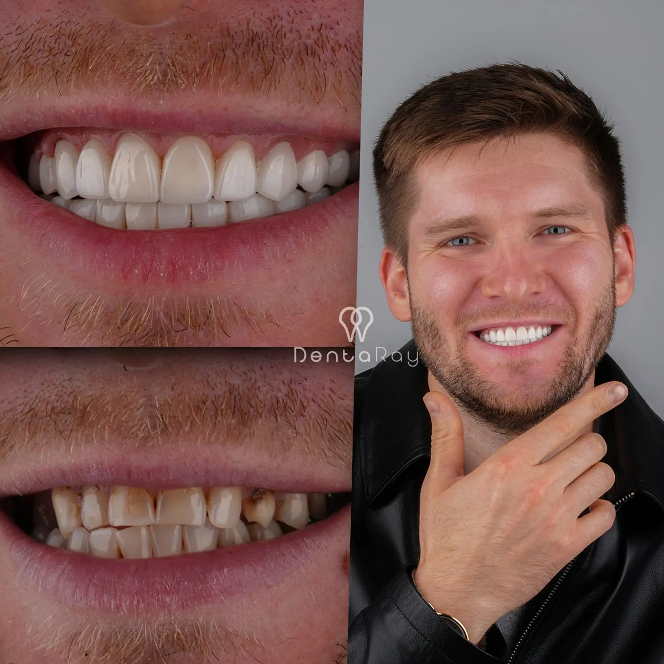 Ideal Candidate for Veneers