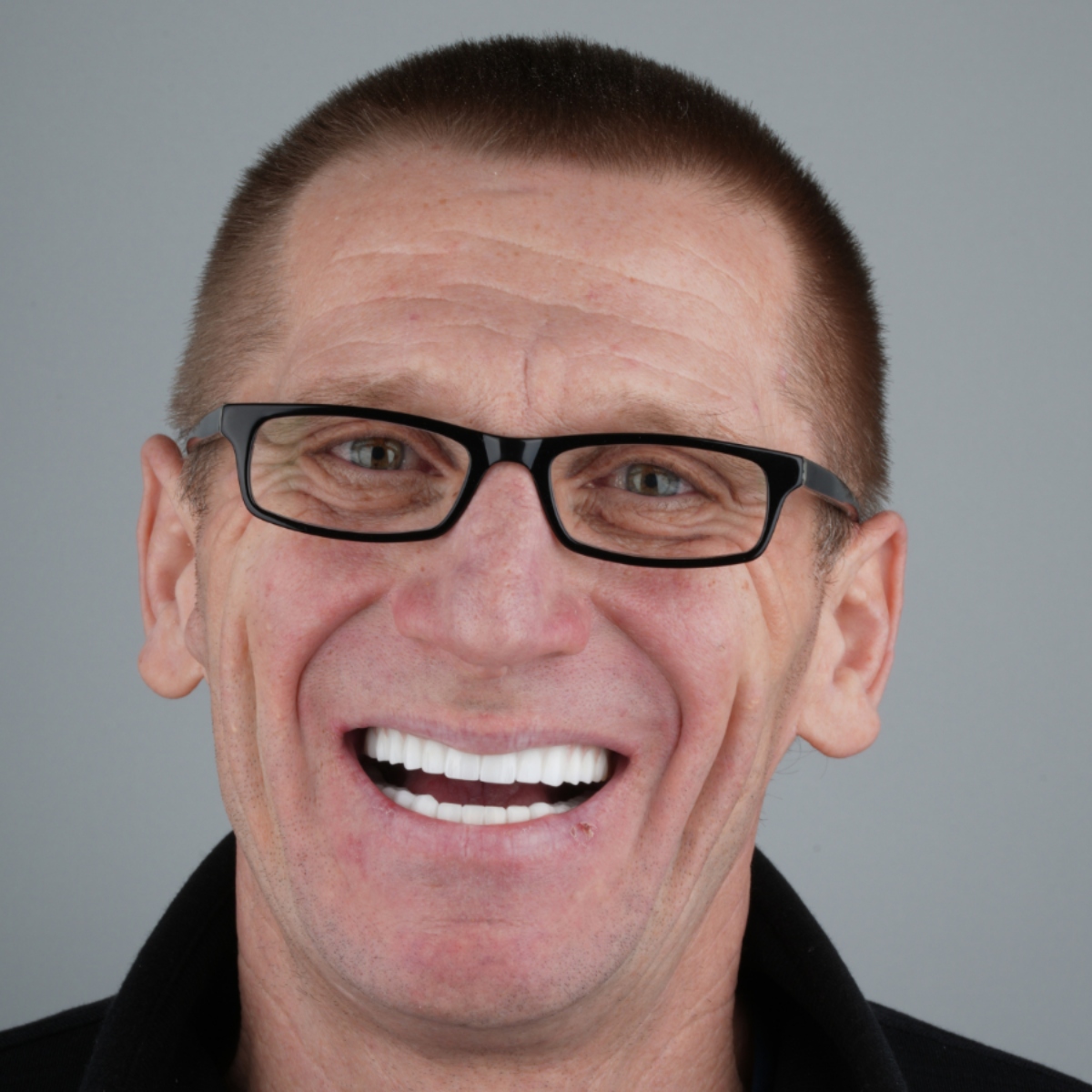Veneers After