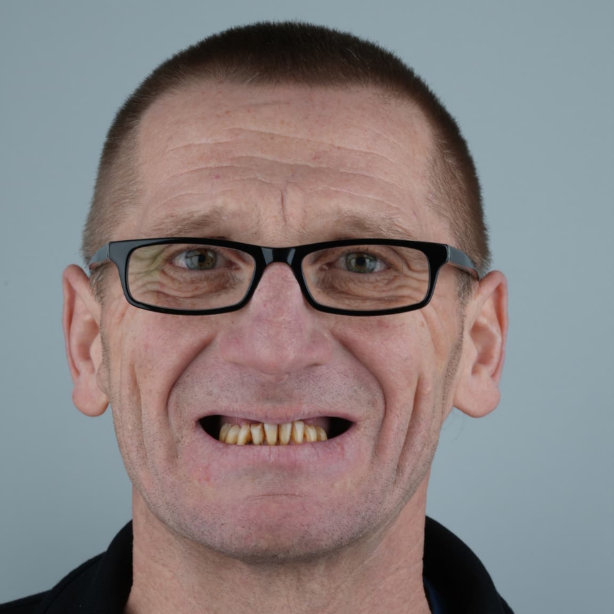 Veneers Before