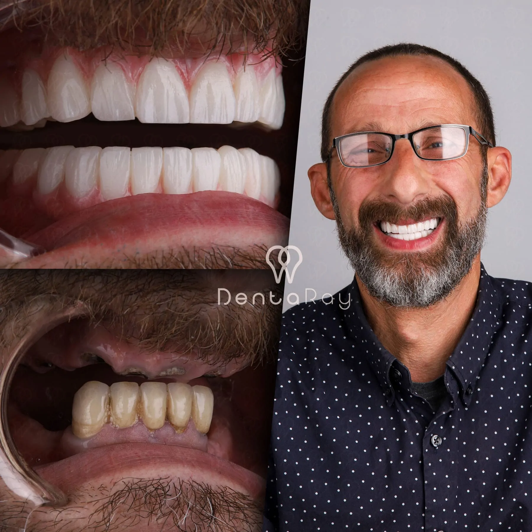 Dentaray Dental Implant Case 5