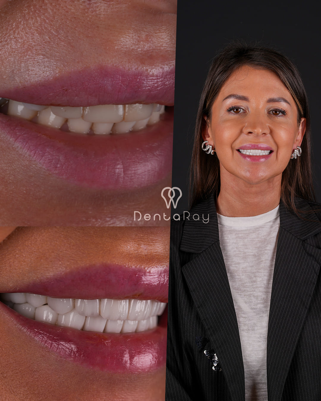 Anna Sterling Porcelain Veneers