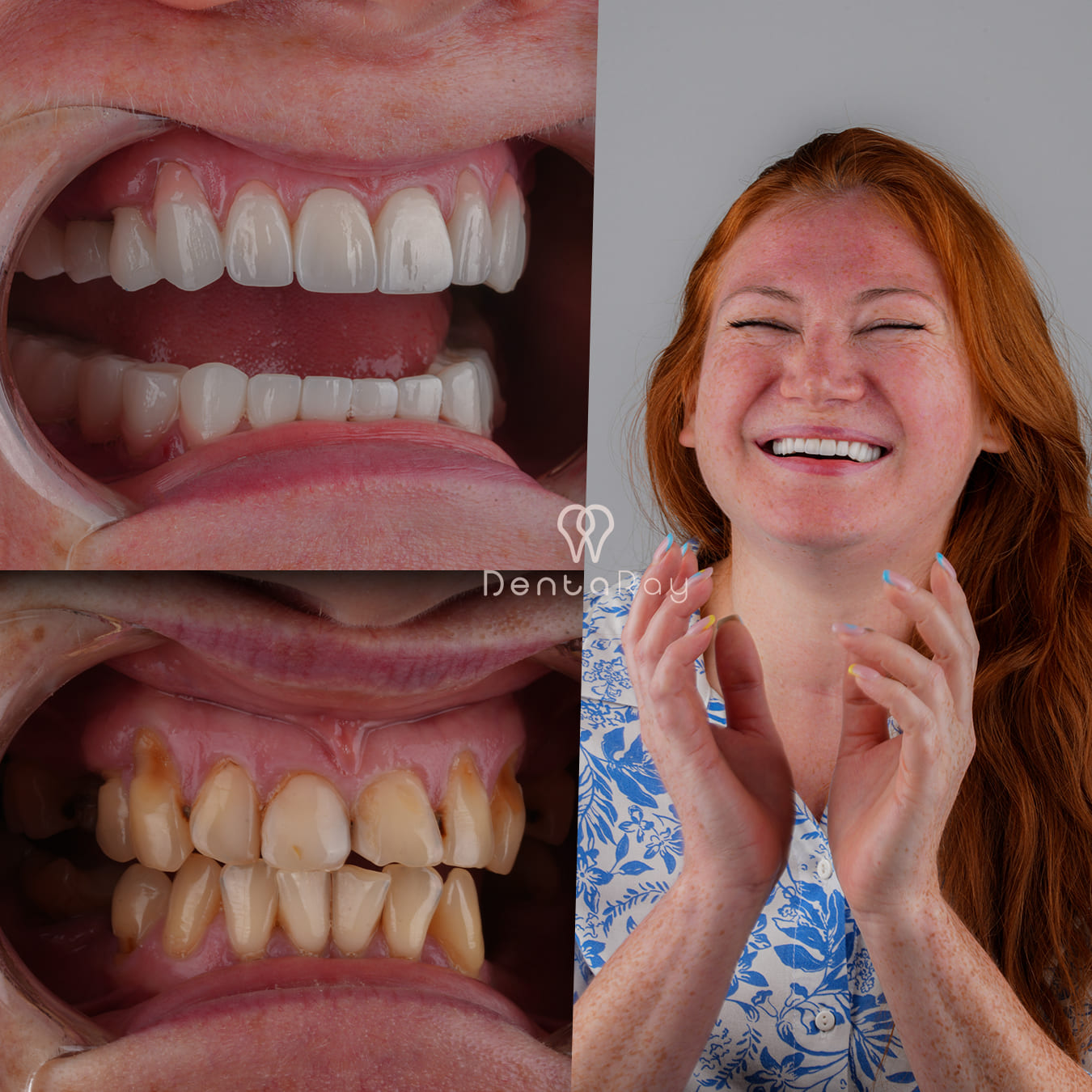 Dentaray Hollywood Smile Transformation 1