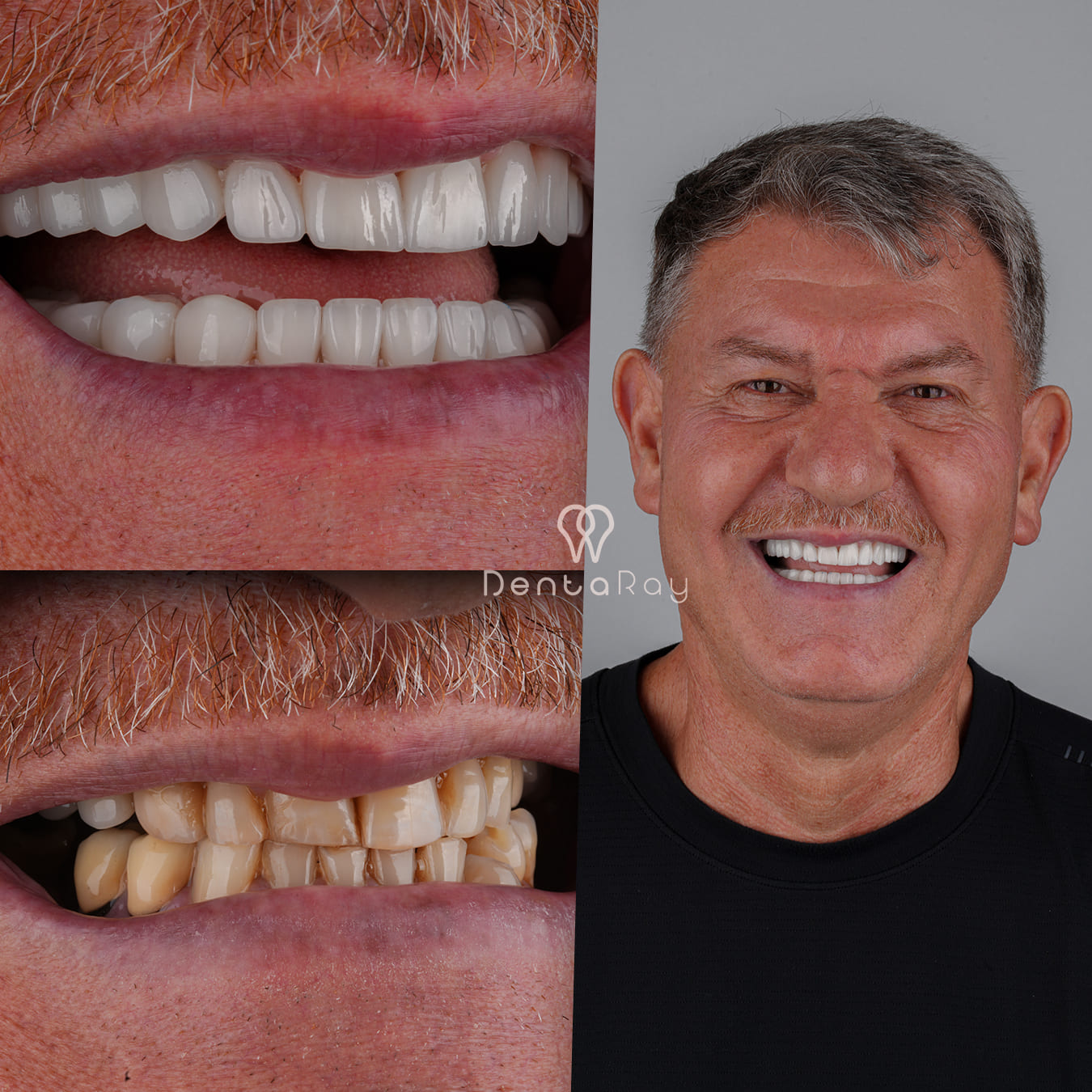 Dentaray Hollywood Smile Transformation 2