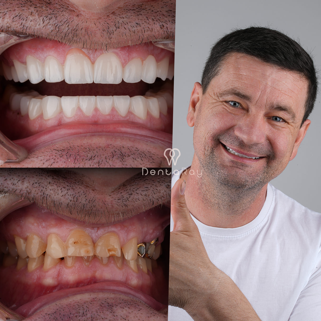 Dentaray Hollywood Smile Transformation 3