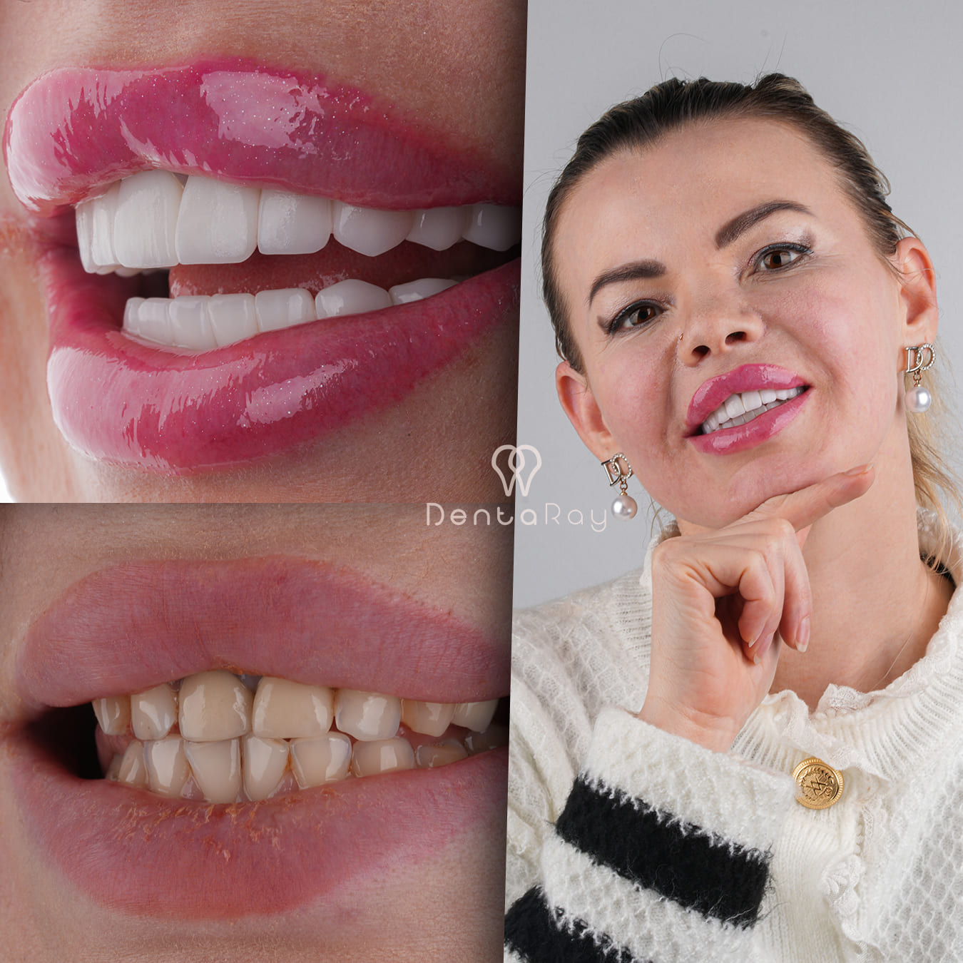Dentaray Hollywood Smile Transformation 4