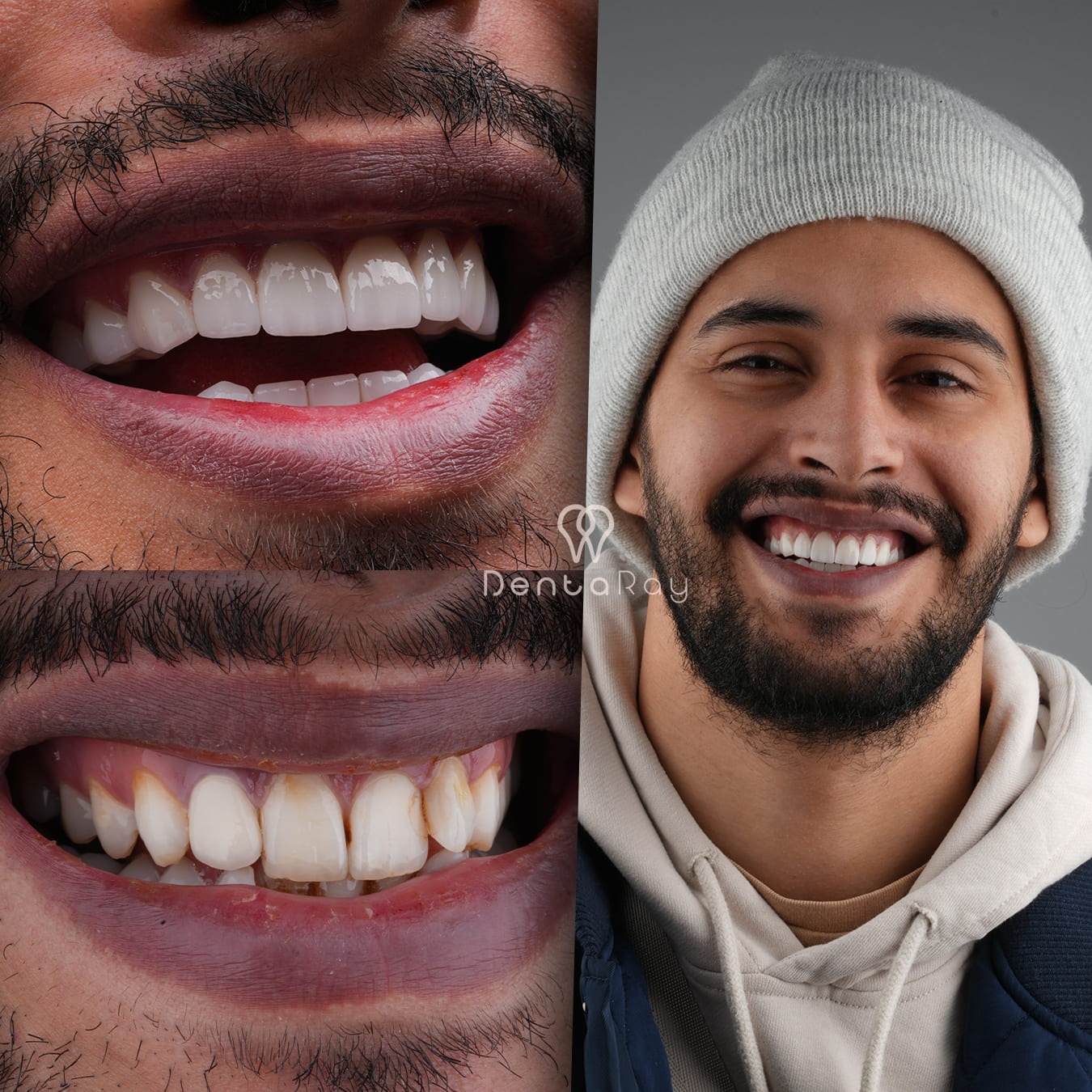 Dentaray Hollywood Smile Transformation 5