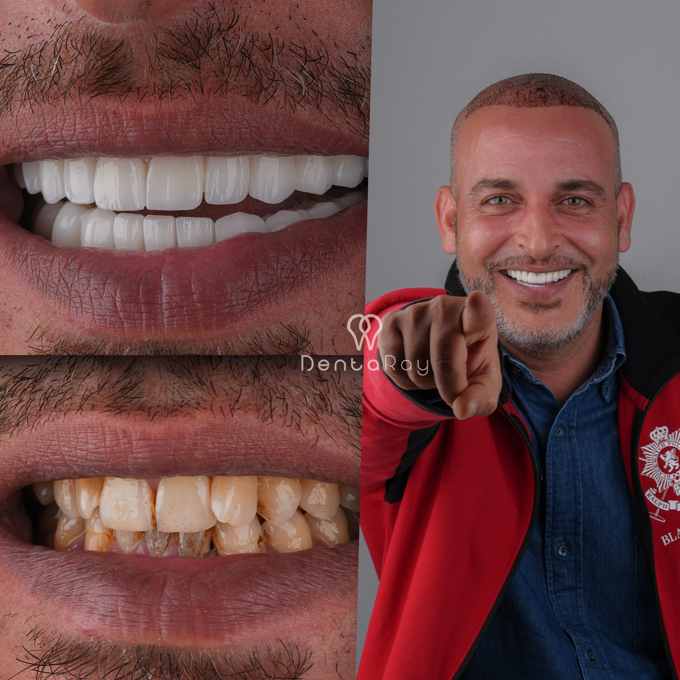 Dentaray Hollywood Smile Transformation 6
