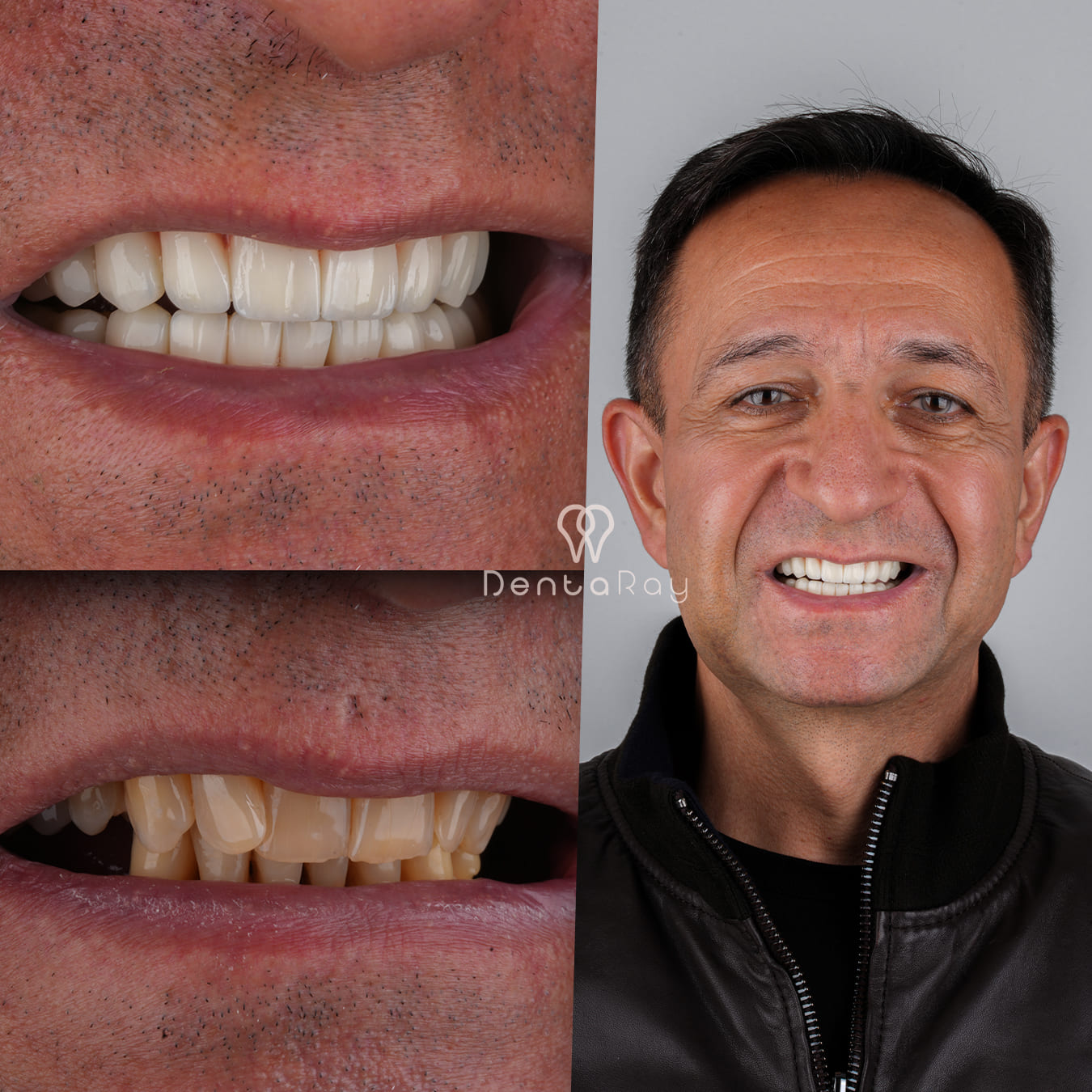 Dentaray Hollywood Smile Transformation 7