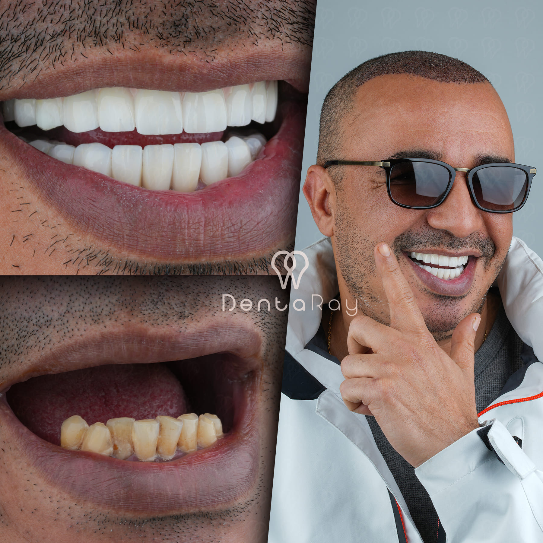 Dentaray Dental Implant Case 1