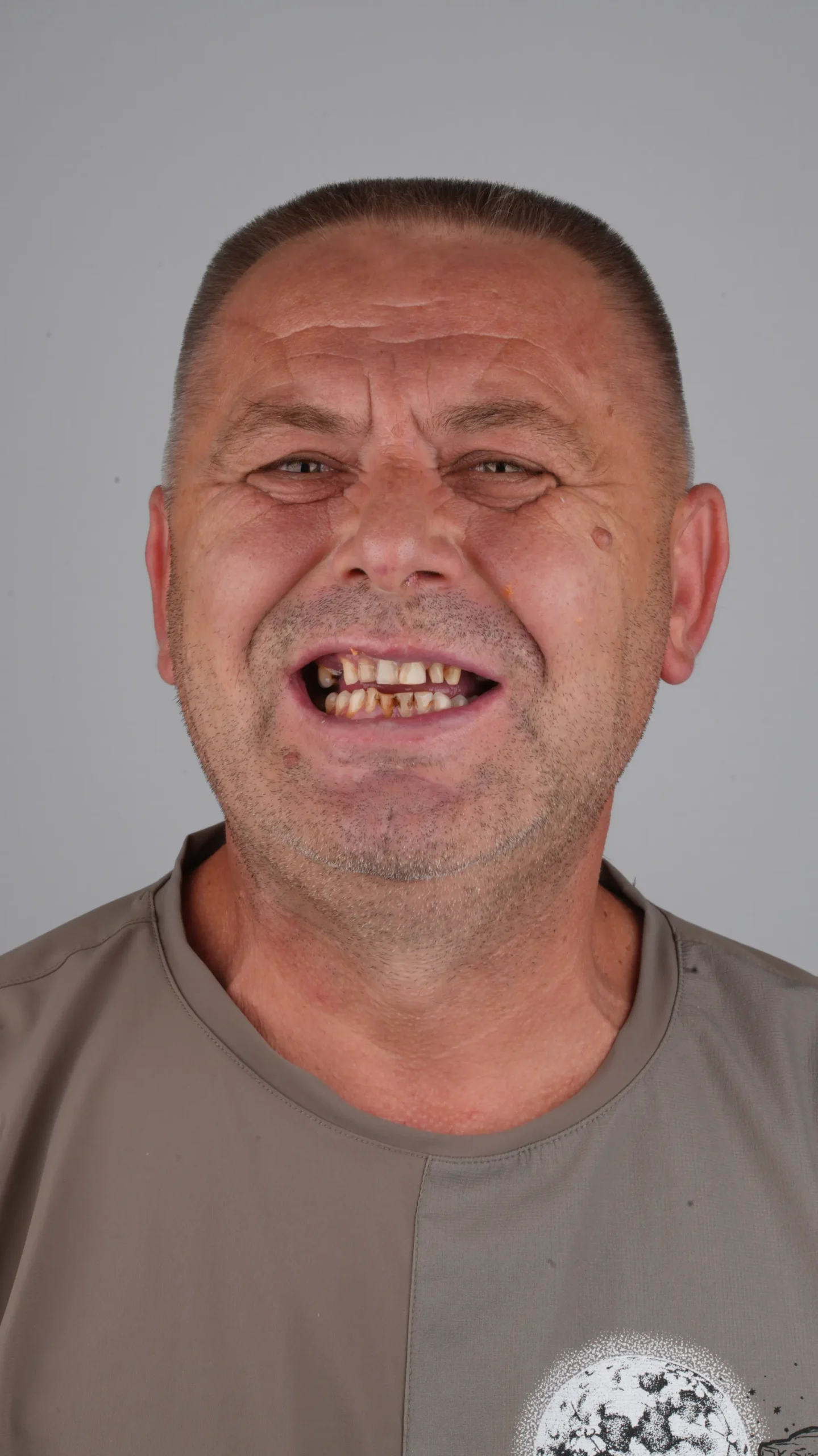 Before Veneer Transformation
