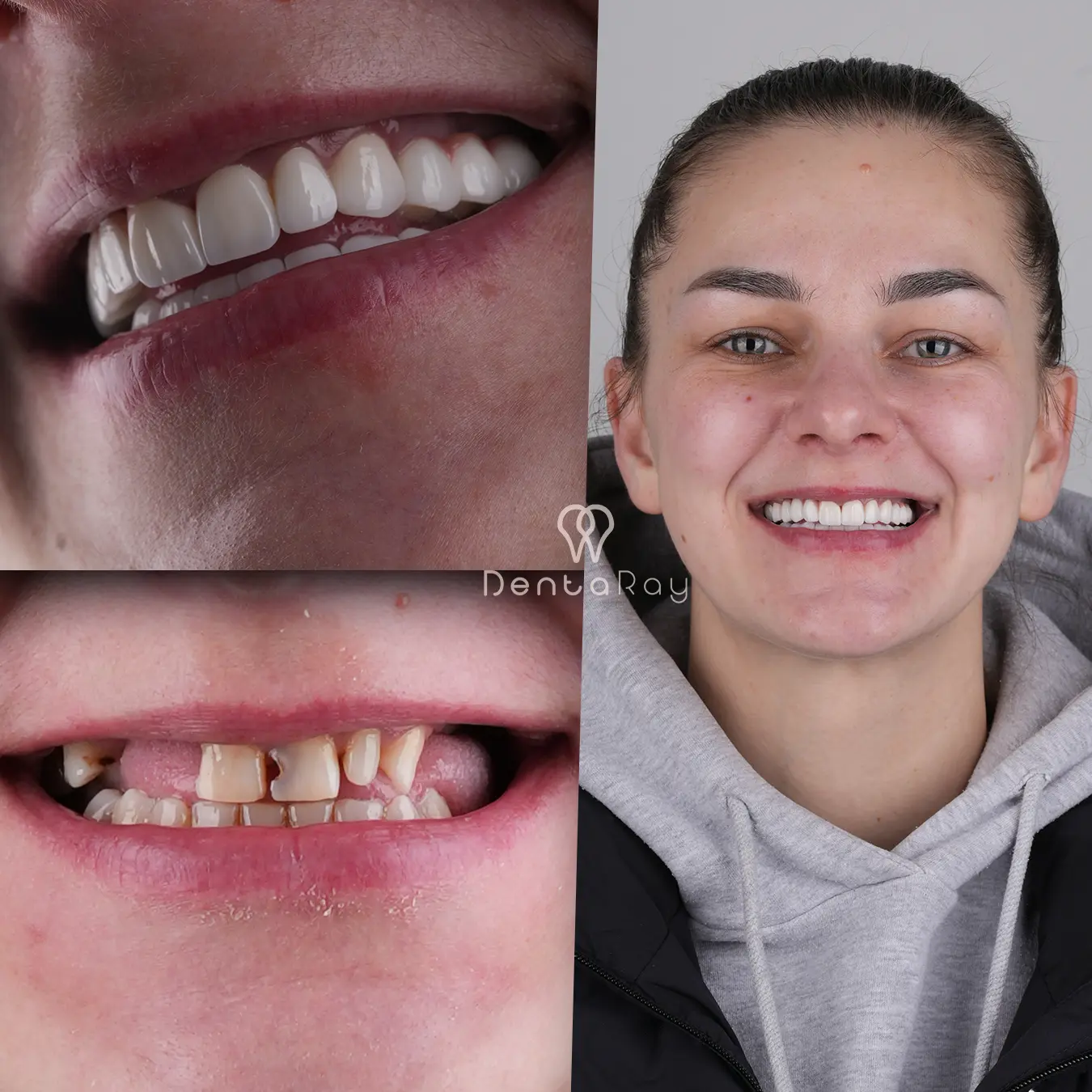 Anhelina Veneer Makeover