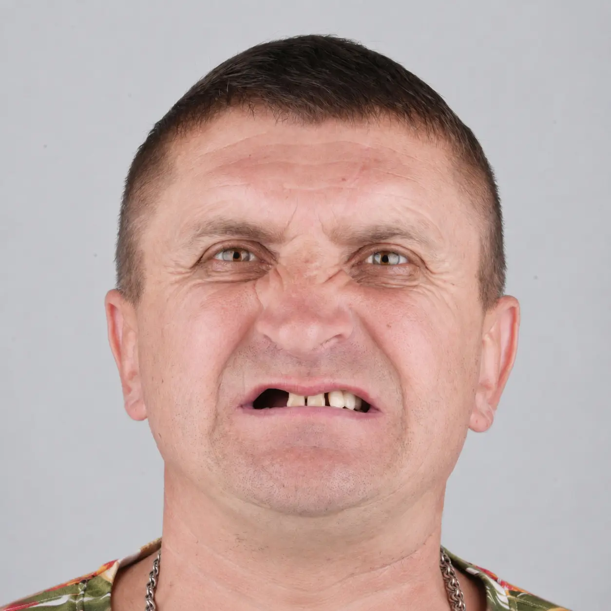 Anna After Treatment