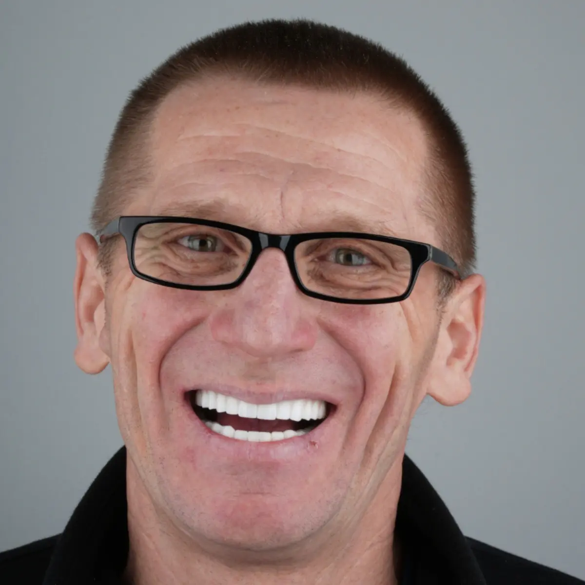 Veneers After