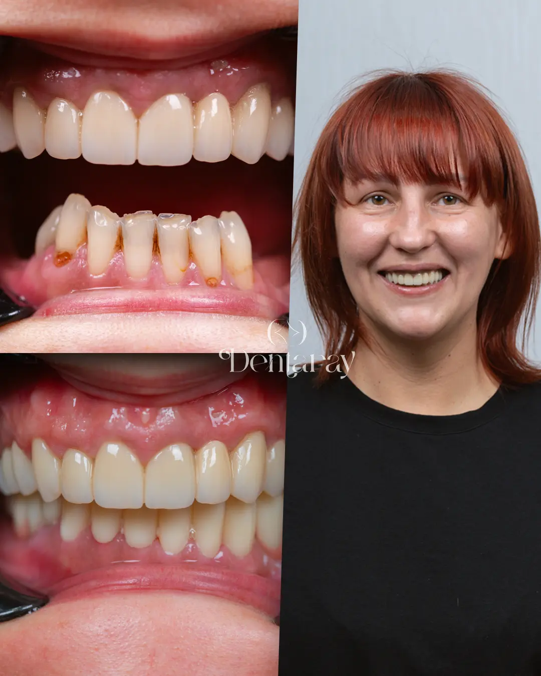 Dentaray Hollywood Smile Transformation 9