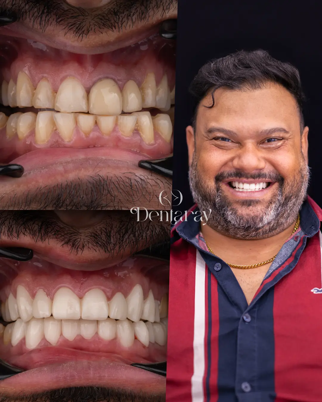 Dentaray Hollywood Smile Transformation 11