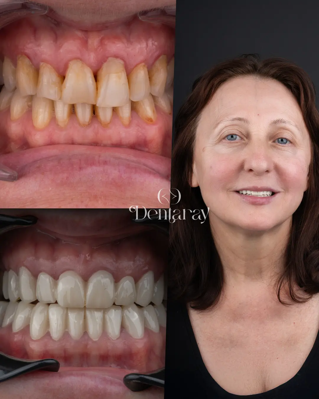 Dentaray Hollywood Smile Transformation 12