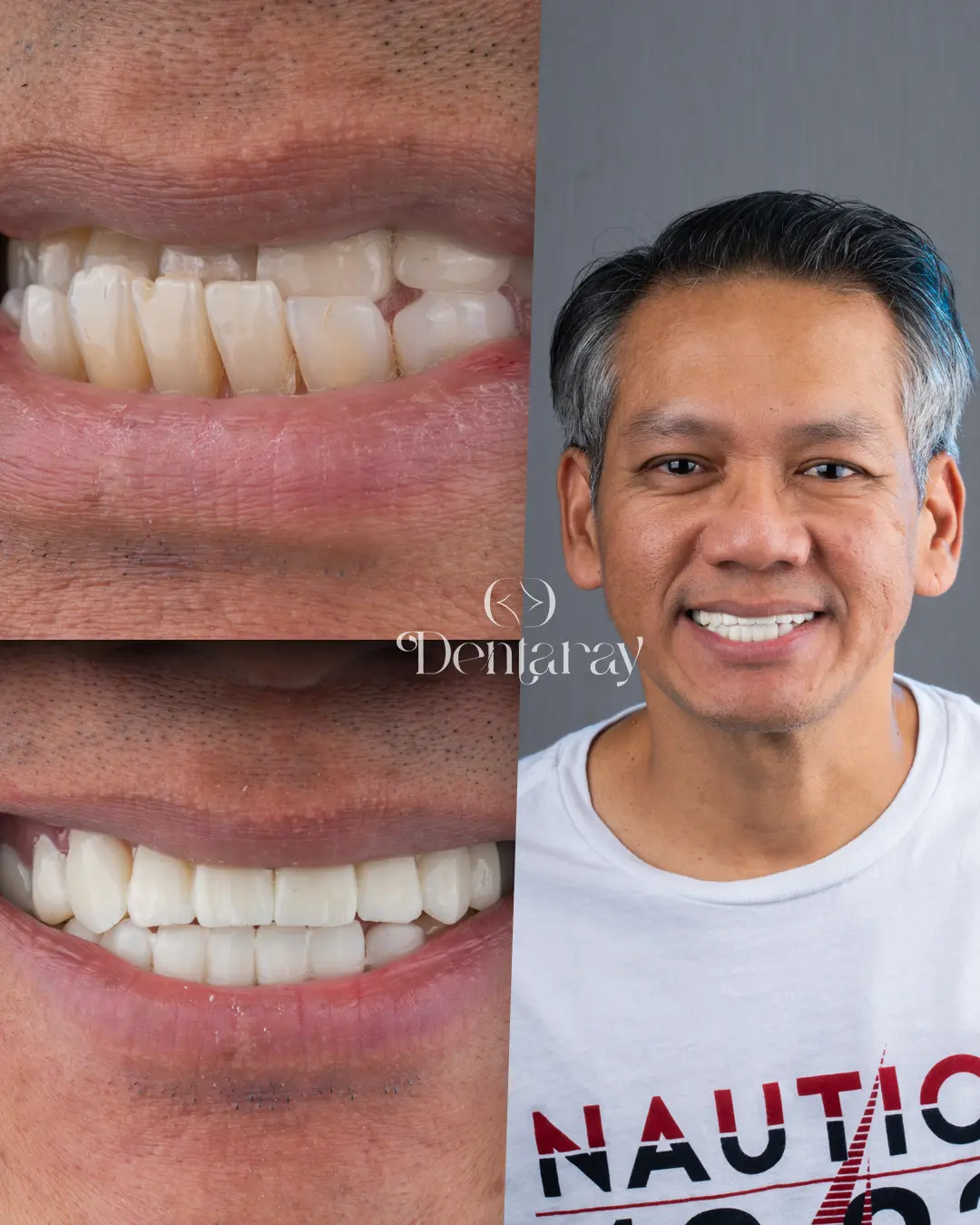 Dentaray Hollywood Smile Transformation 13