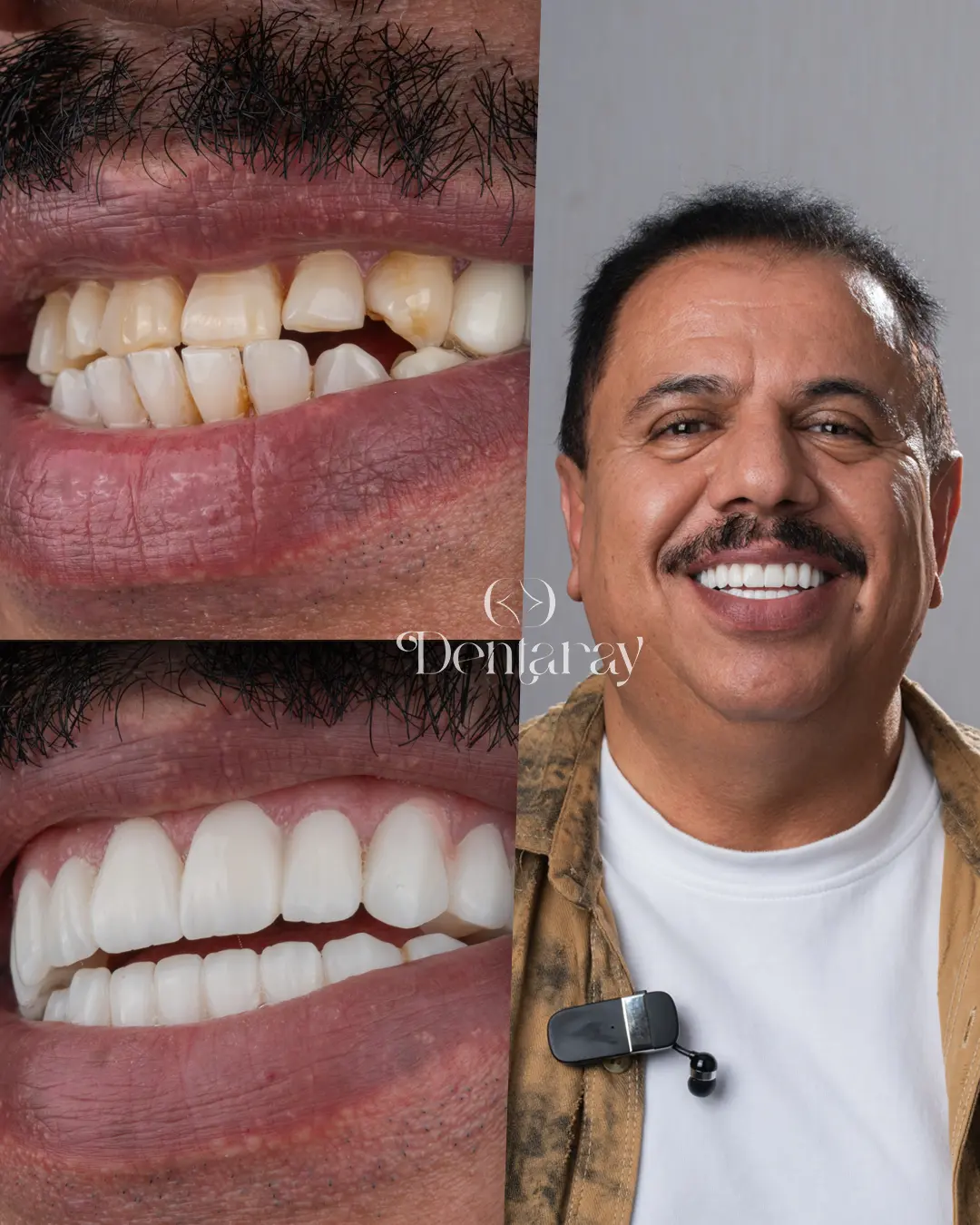 Dentaray Hollywood Smile Transformation 15