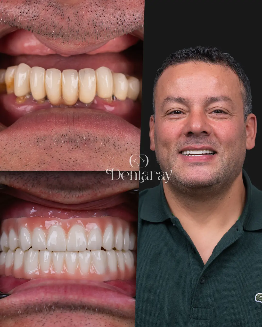 Dentaray Hollywood Smile Transformation 16