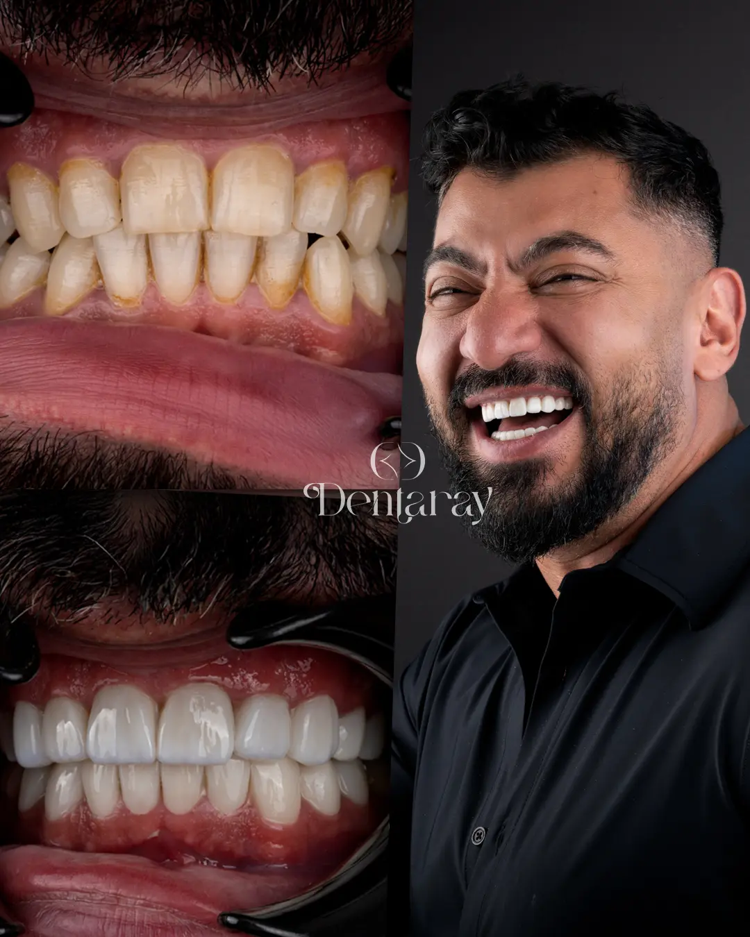 Dentaray Hollywood Smile Transformation 17
