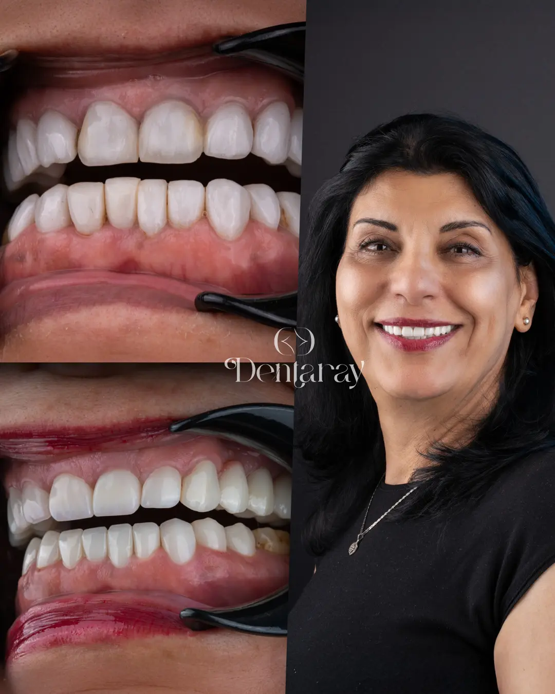 Dentaray Hollywood Smile Transformation 18