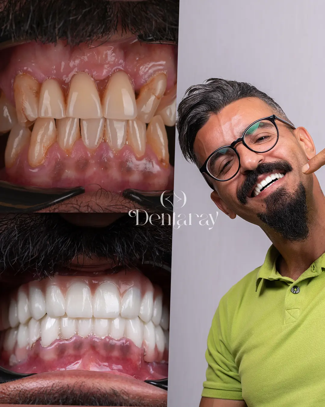 Dentaray Hollywood Smile Transformation 19