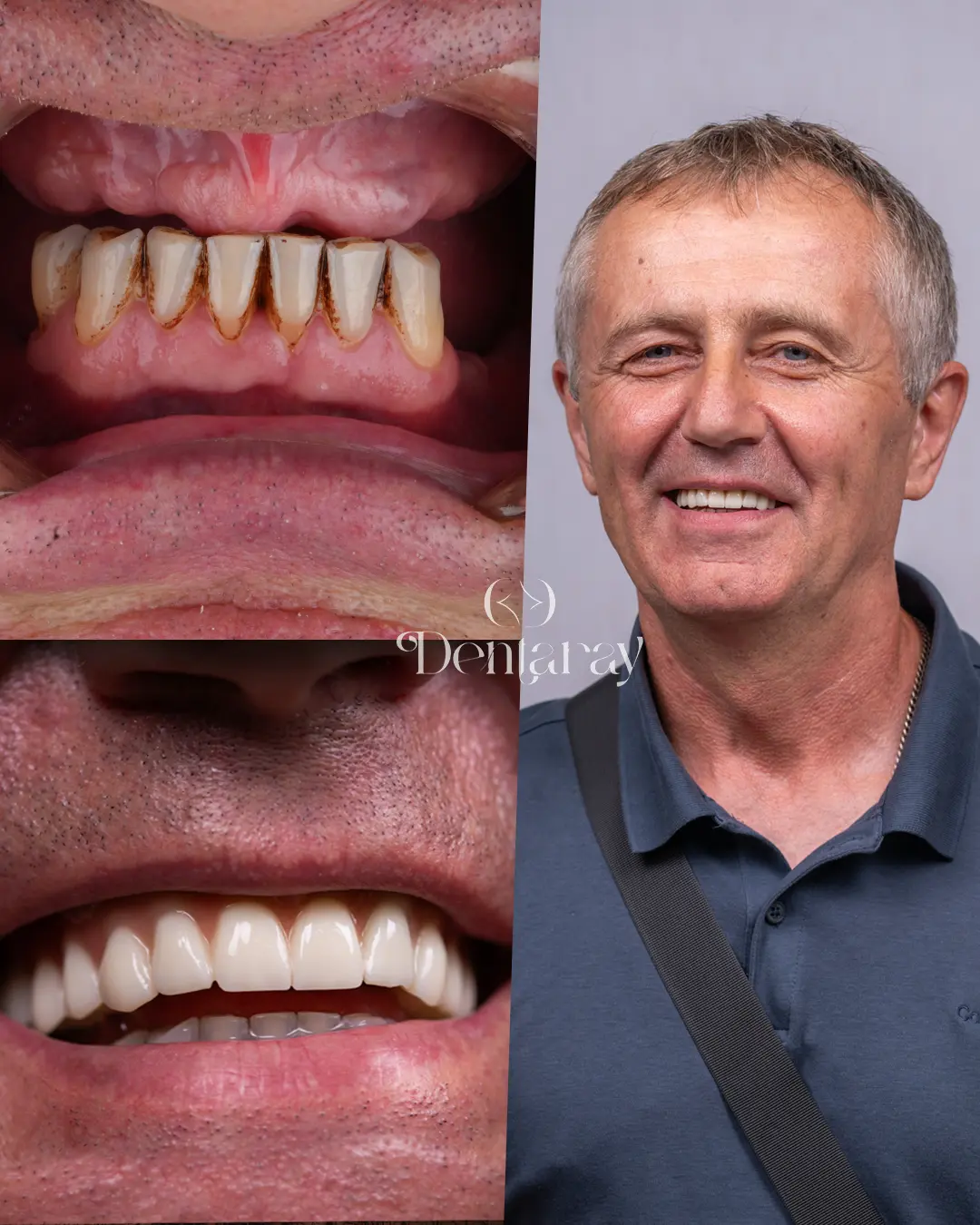 Dentaray Hollywood Smile Transformation 21