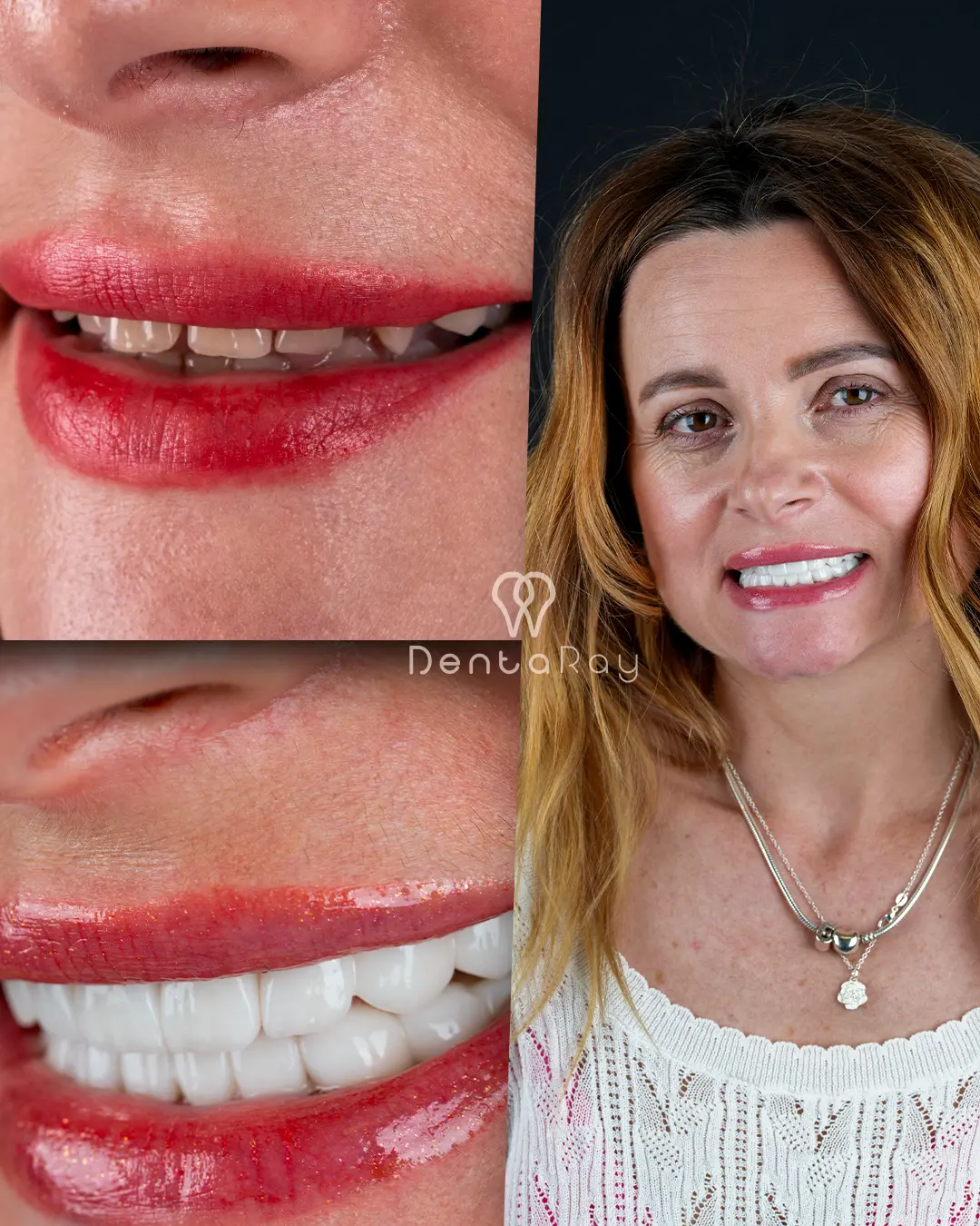 Dentaray Hollywood Smile Transformation 14