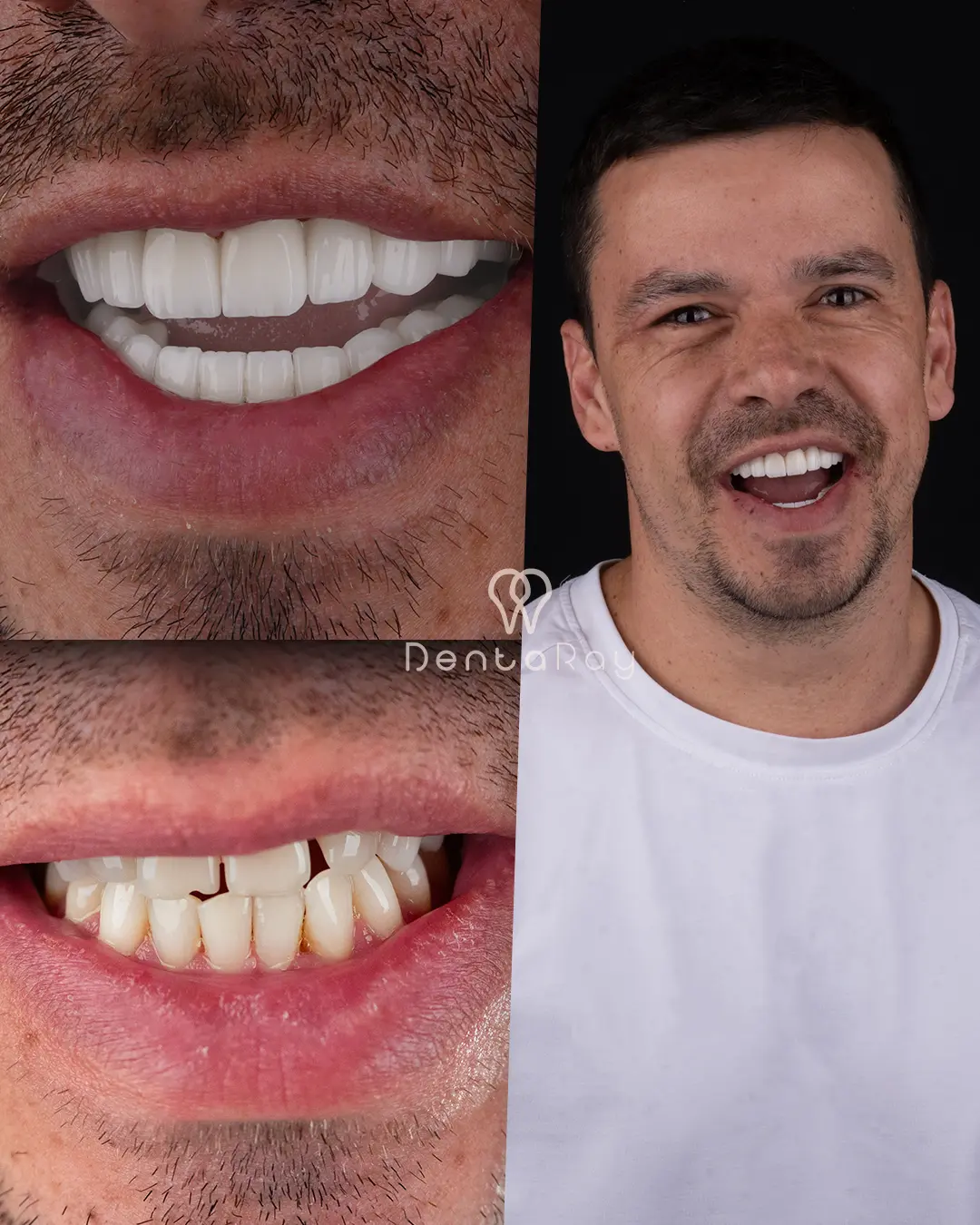 Dentaray Hollywood Smile Transformation 20