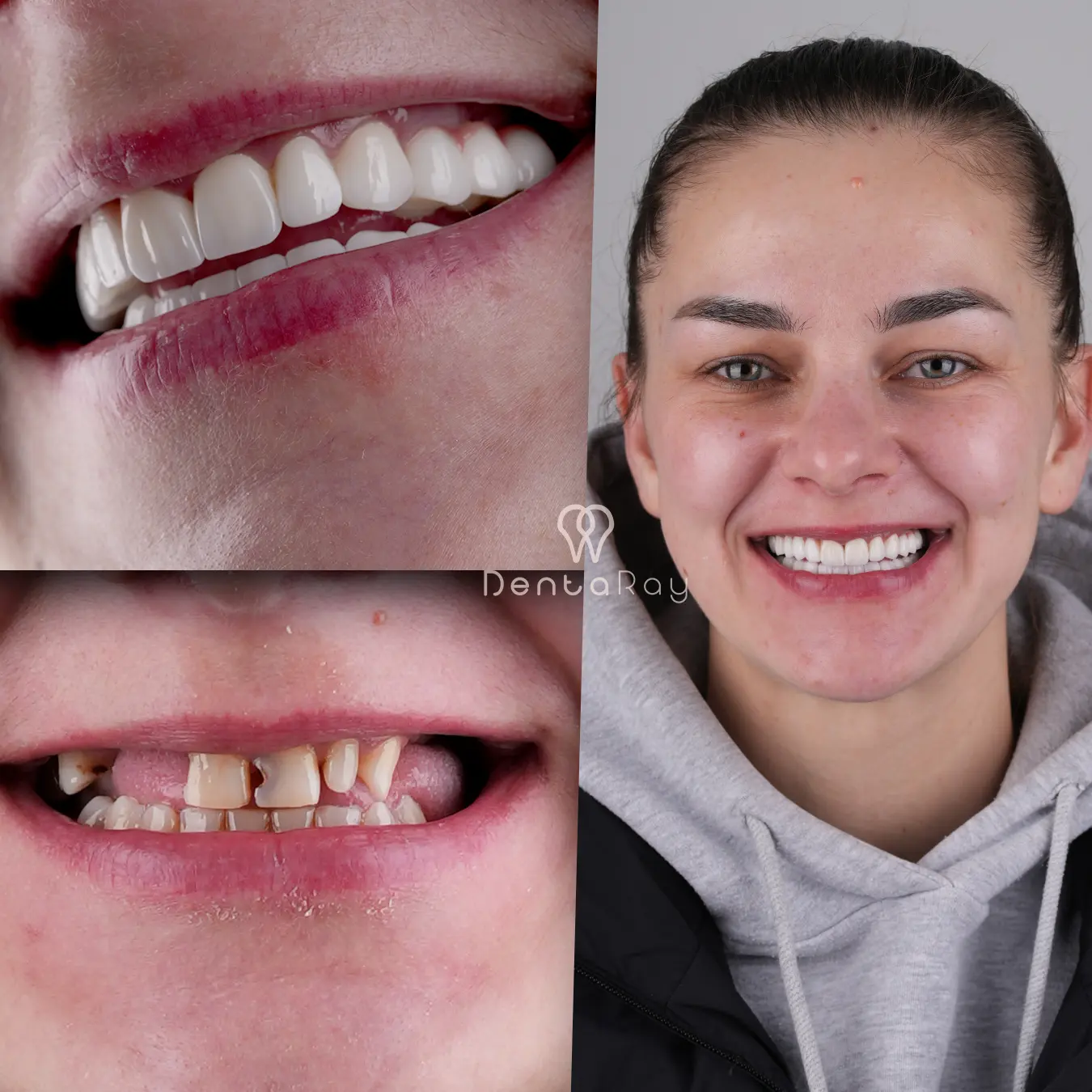 Dentaray Hollywood Smile Transformation 22